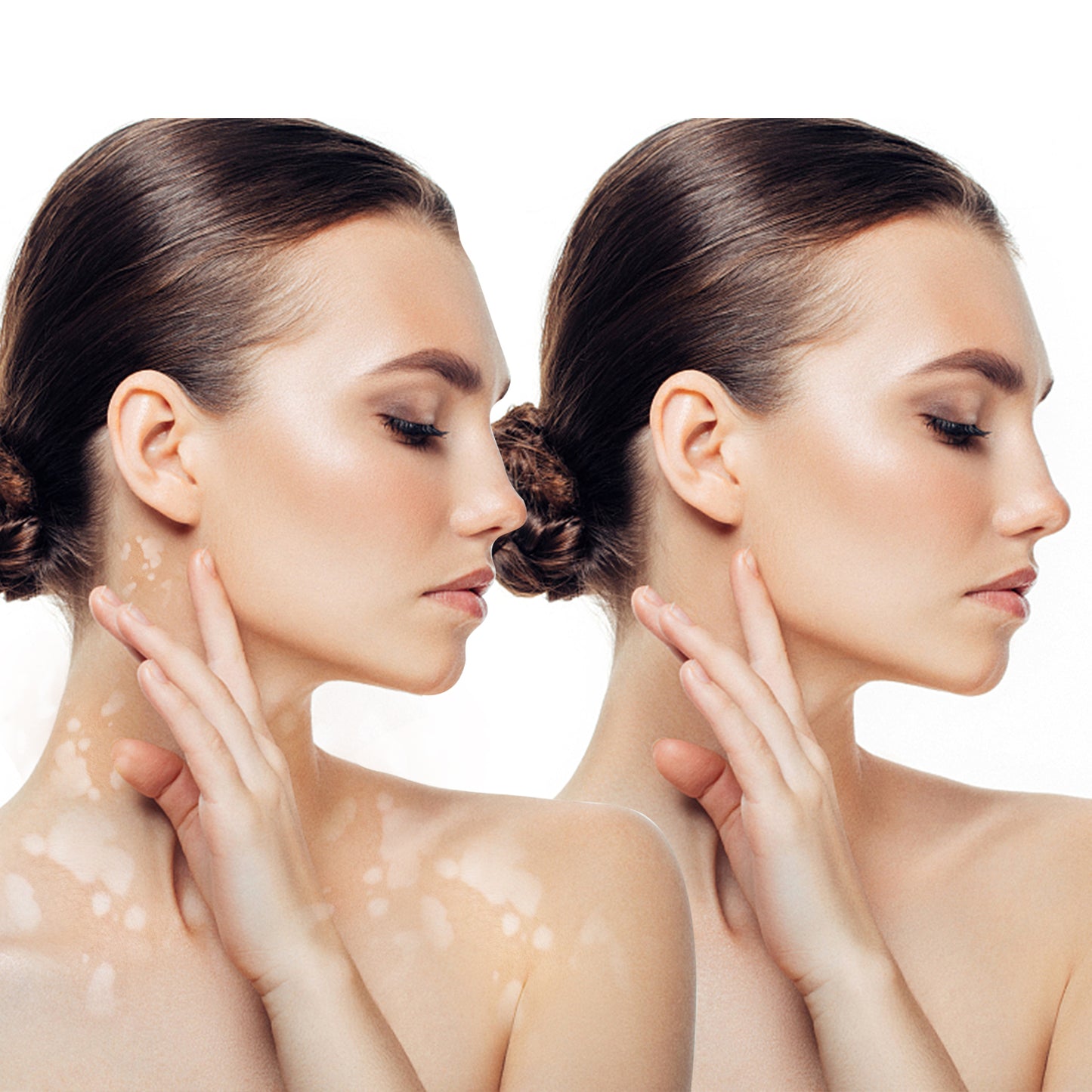 Sumifun 6 Counts Vitiligo Cream