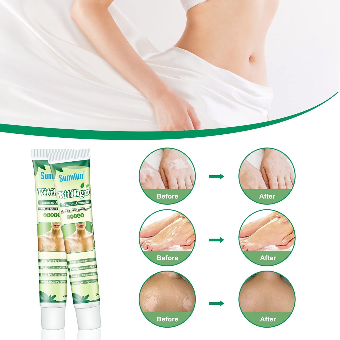 Sumifun 6 Counts Vitiligo Cream