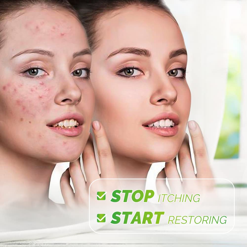 Sumifun Eczema Psoriasis Cream