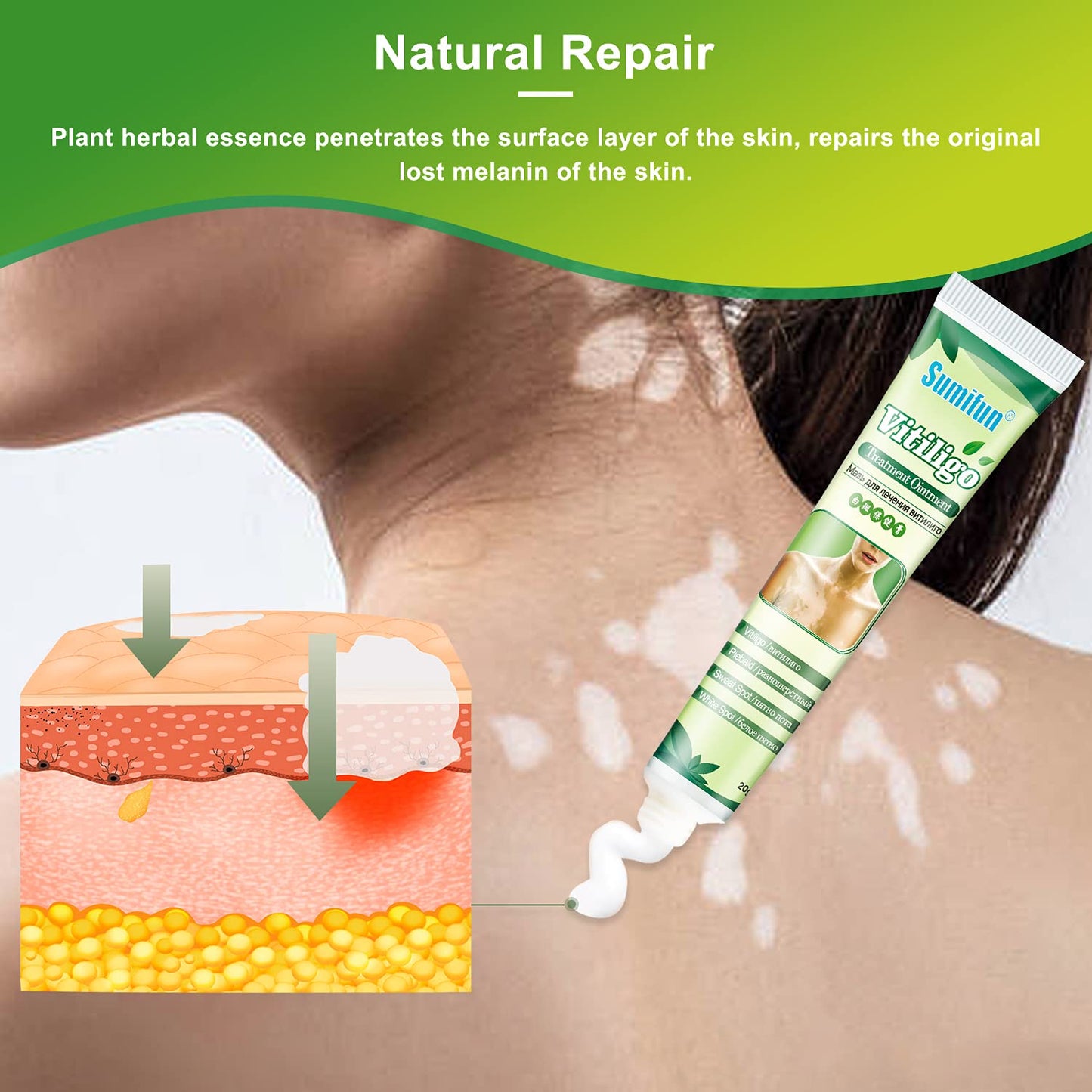 Sumifun 6 Counts Vitiligo Cream
