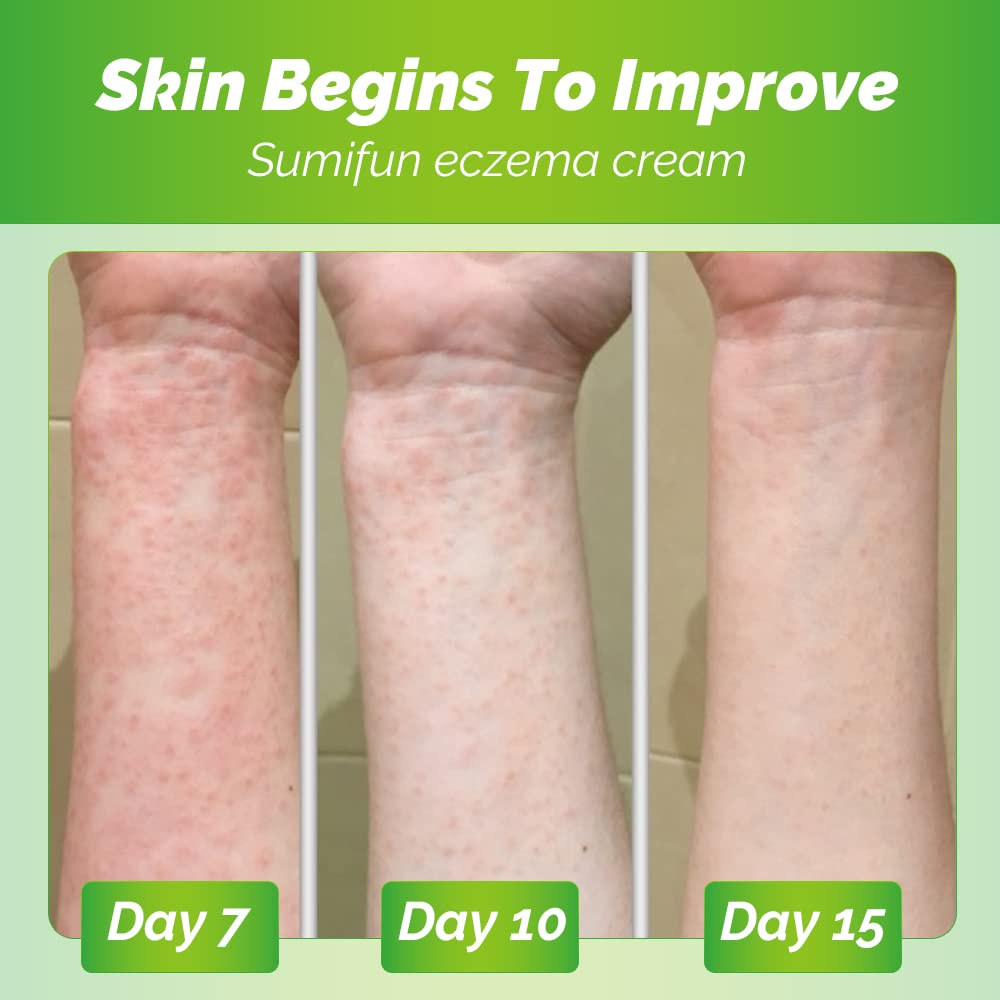 Sumifun Eczema Psoriasis Cream