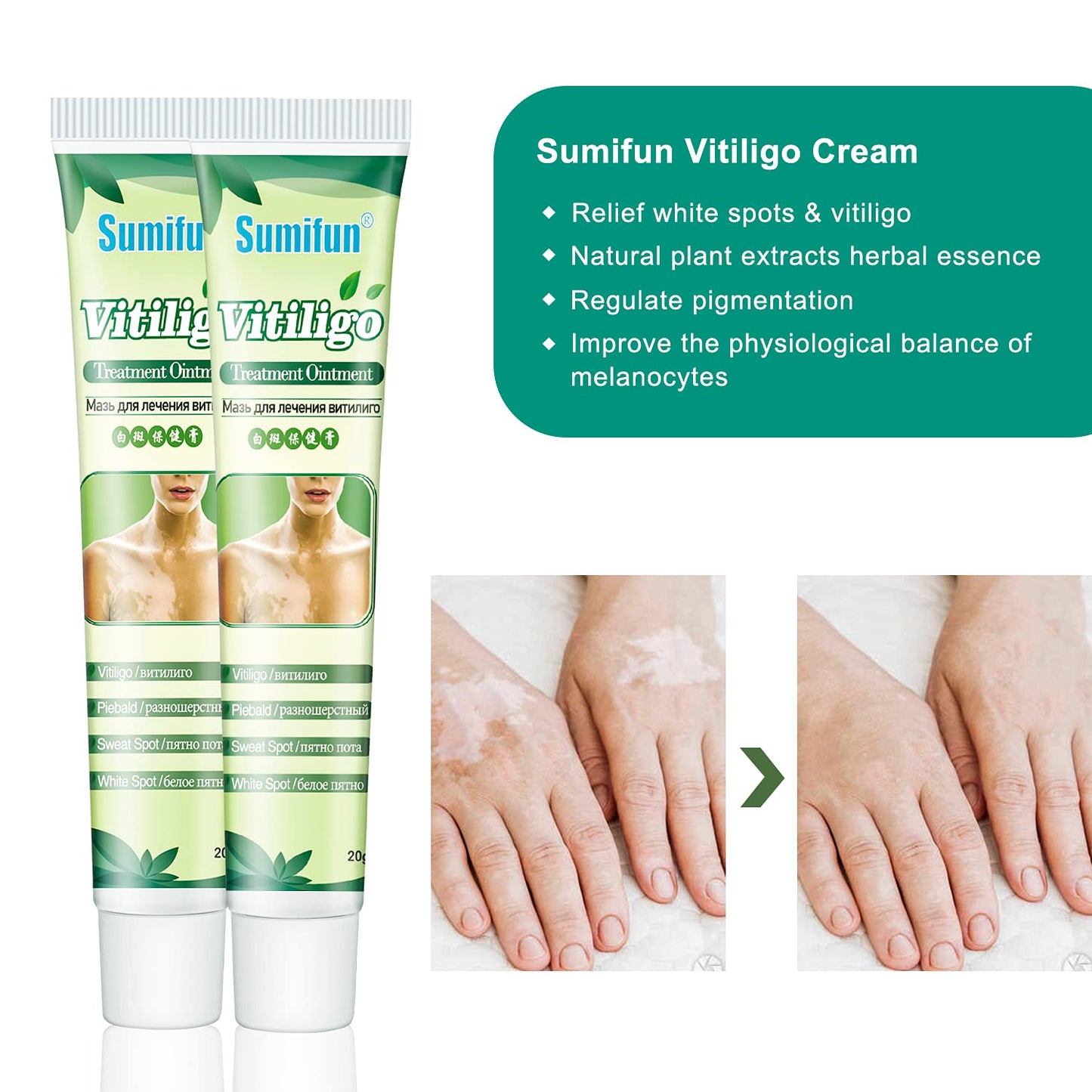 Sumifun 6 Counts Vitiligo Cream