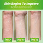 Sumifun Eczema Psoriasis Cream